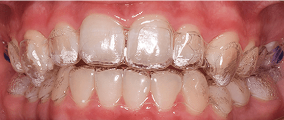 Clear aligners