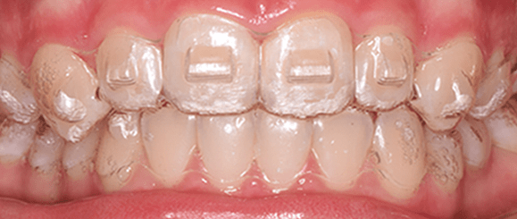 Aligners Off-Track? 2 Clear aligners