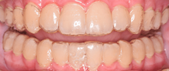 Clear aligners