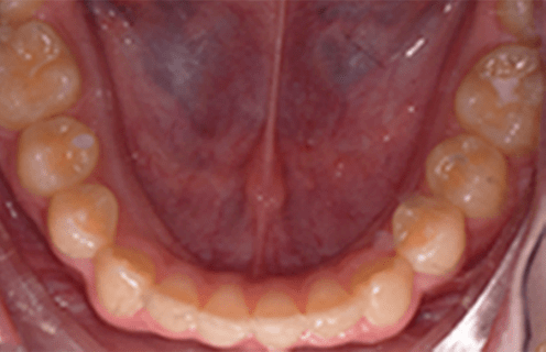 orthodontic retention case study