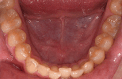 HFV for Orthodontic Retention 2 orthodontic retention case study