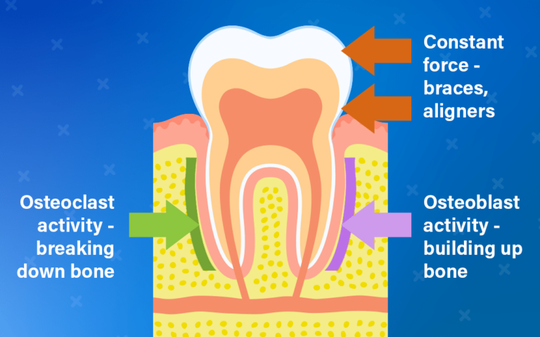 MOPs and Orthodontic Tooth Movement 1 MOPs diagram