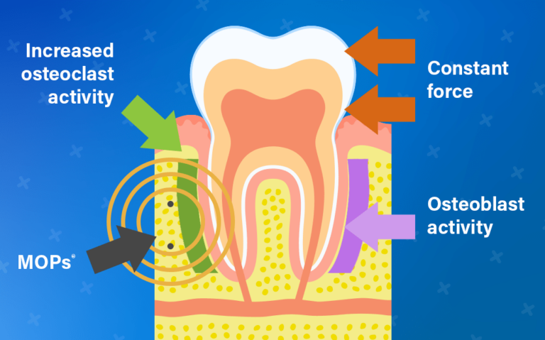 MOPs and Orthodontic Tooth Movement 2 MOPs diagram