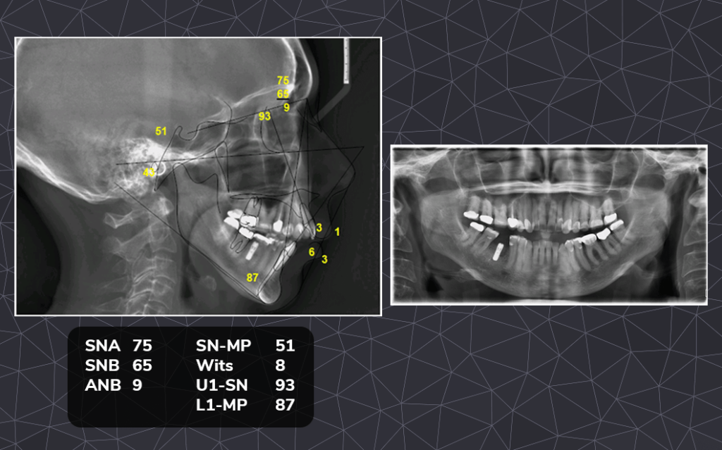 Dr. Bella Shen Garnett Open Bite Case Feature 2 Open Bite Case Study