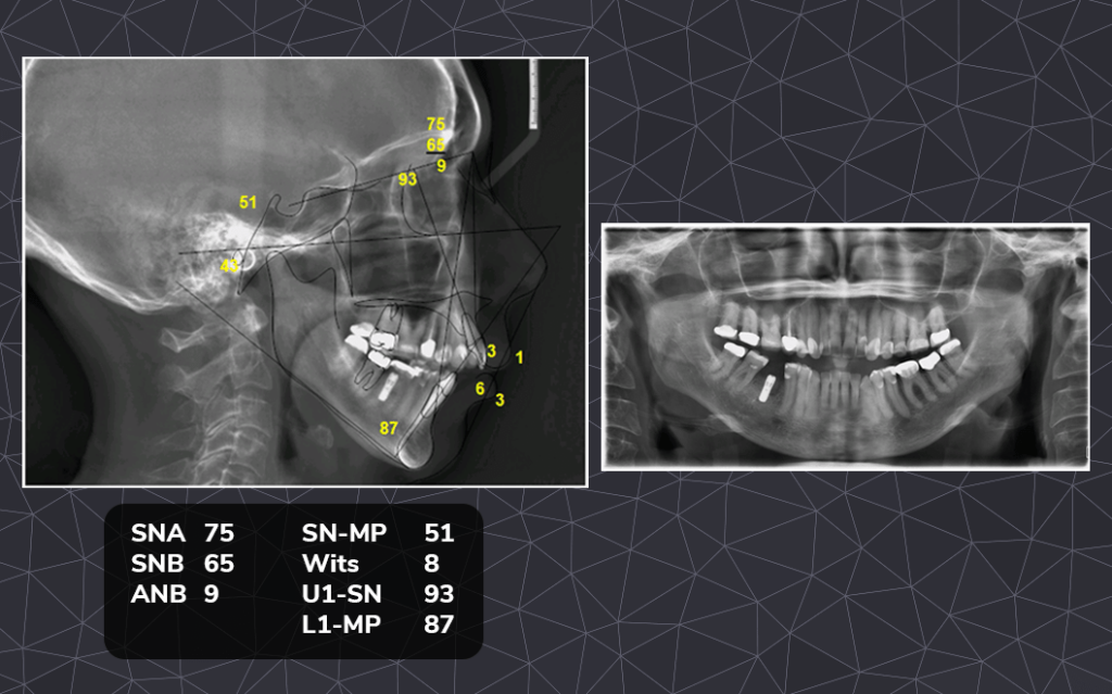 Open Bite Case Study