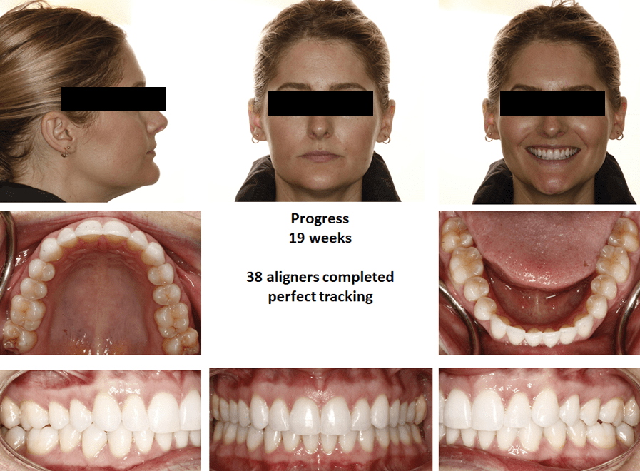 Dr. Bill Dischinger Deep Bite Case Feature 4 Deep Bite Case Study