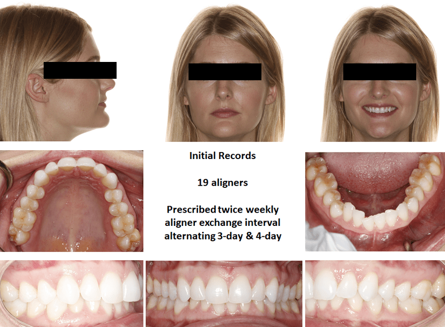 Dr. Bill Dischinger Deep Bite Case Feature 1 Deep Bite Case Study