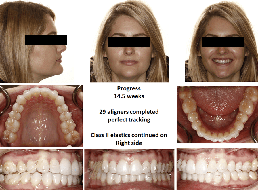 Dr. Bill Dischinger Deep Bite Case Feature 3 Deep Bite Case Study