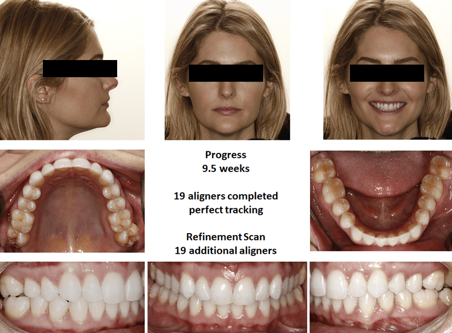 Dr. Bill Dischinger Deep Bite Case Feature 2 Deep Bite Case Study