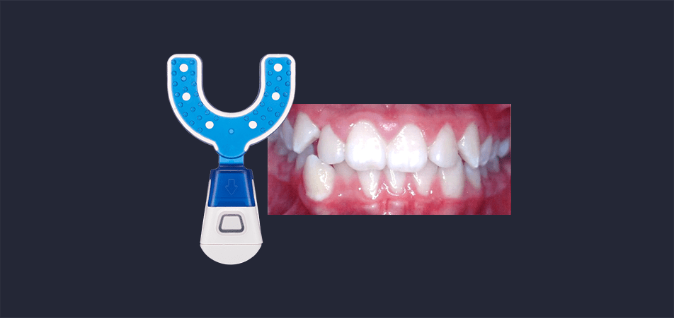 Cross Bite Case Study