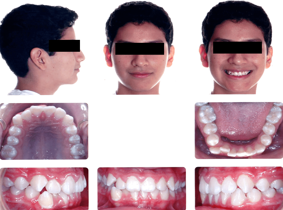 Crossbite (14 Months) 1 Cross Bite Case Study