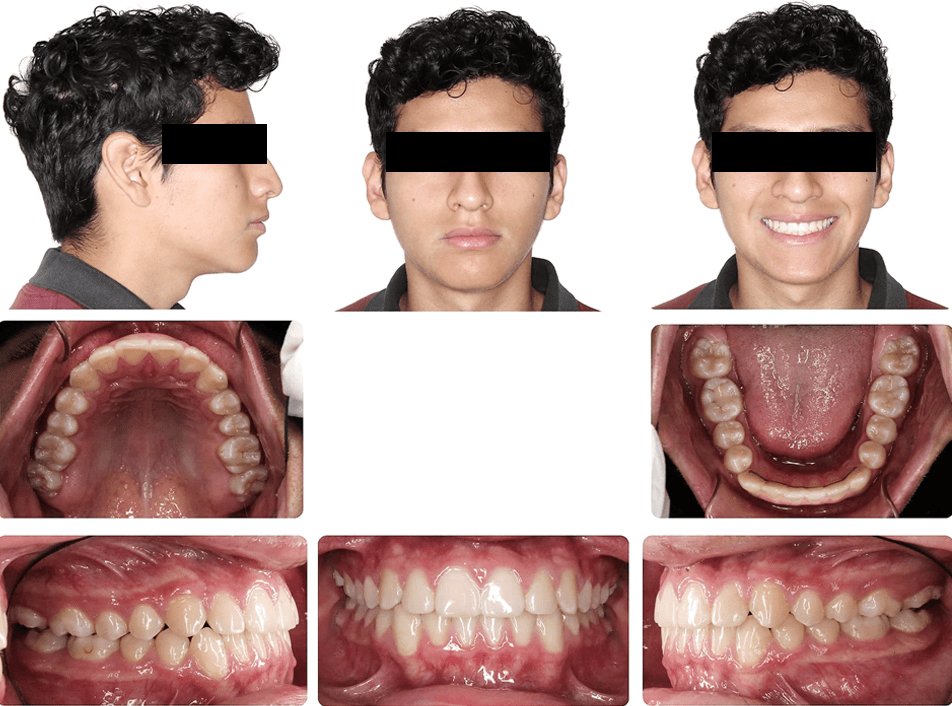 Crossbite (14 Months) 2 Cross Bite Case Study
