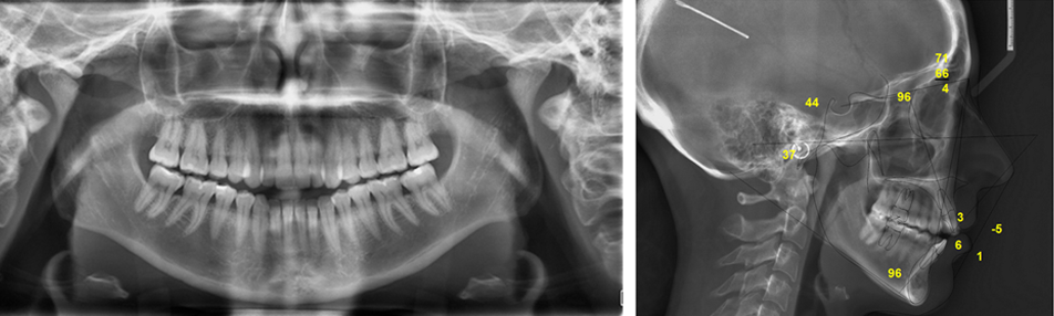 Open Bite Case Study