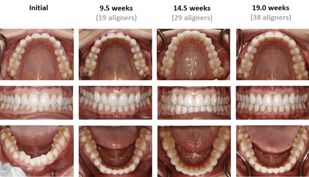 Dr. Bill Dischinger Deep Bite Case Feature 6 Deep Bite Case Study