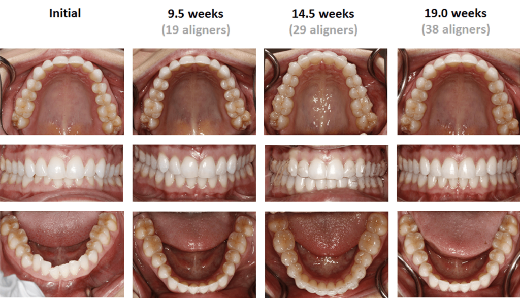 Deep Bite Case Study