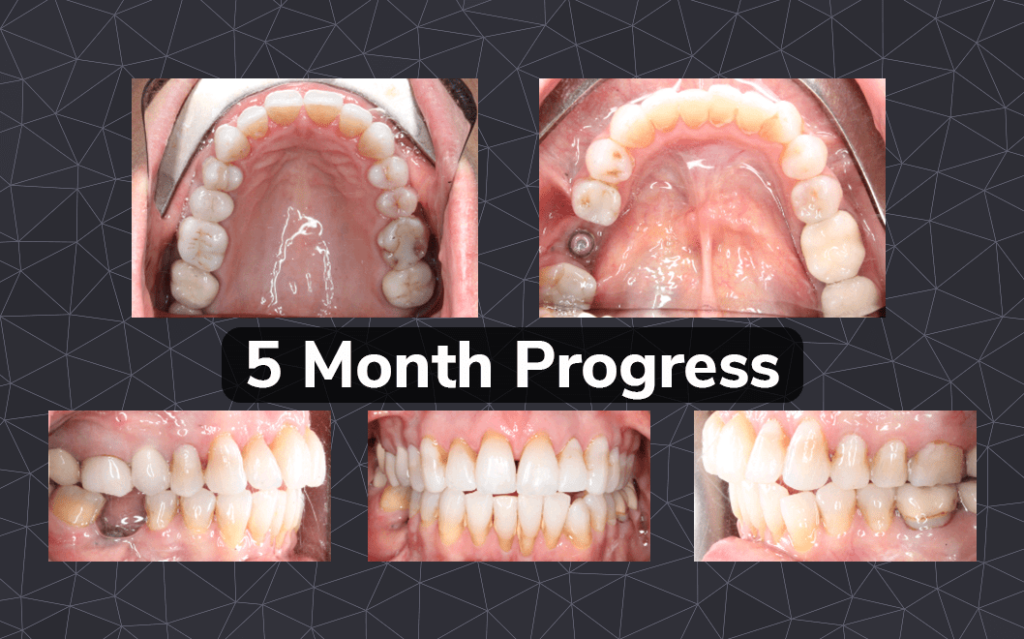 Dr. Bella Shen Garnett Open Bite Case Feature 3 Open Bite Case Study