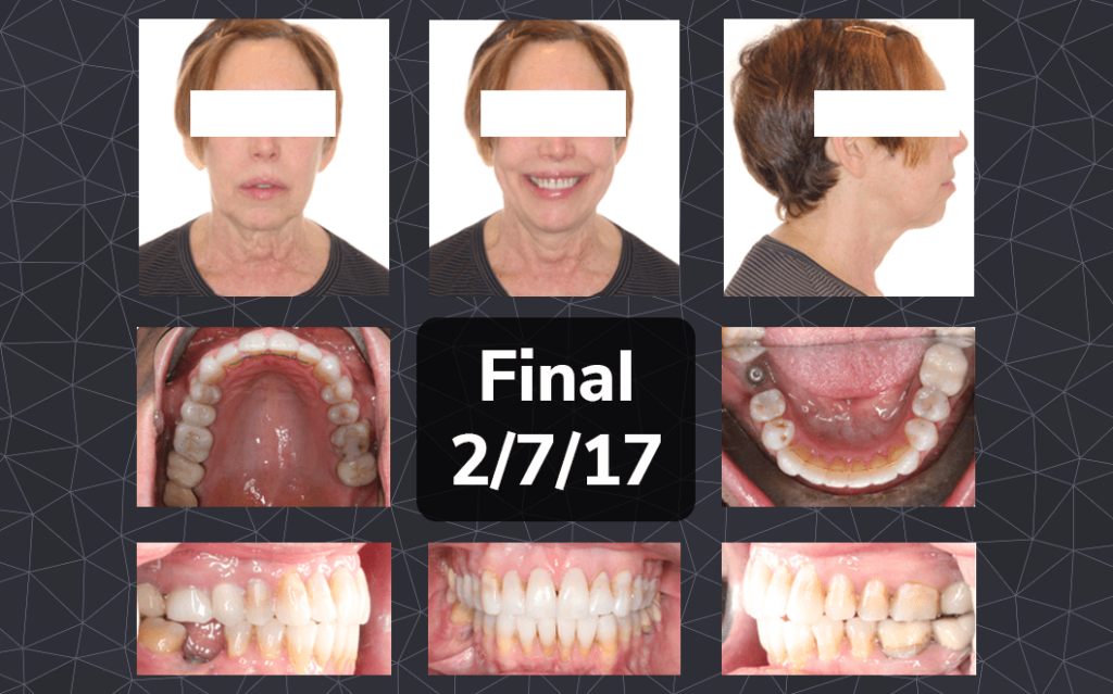 Dr. Bella Shen Garnett Open Bite Case Feature 4 Open Bite Case Study