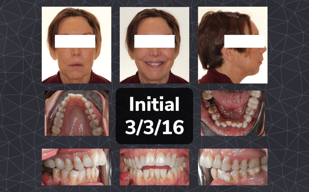 Dr. Bella Shen Garnett Open Bite Case Feature 1 Open Bite Case Study
