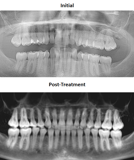 Dr. Bill Dischinger Deep Bite Case Feature 5 Deep Bite Case Study