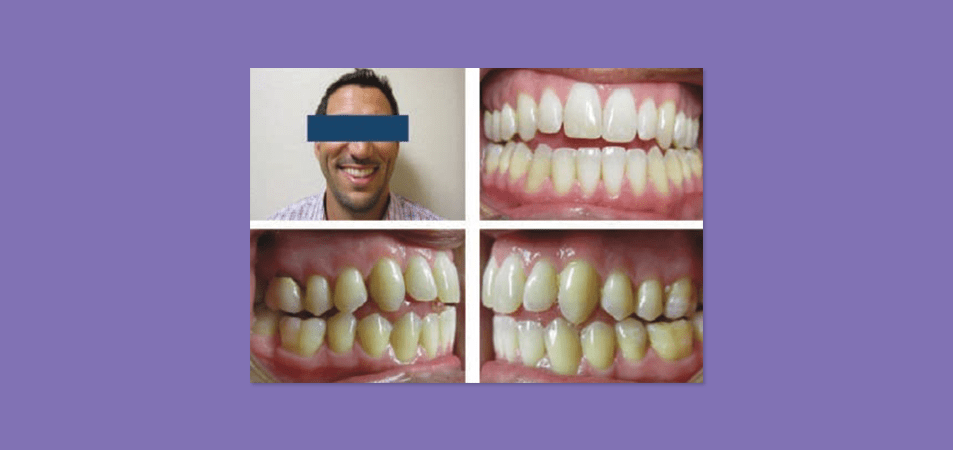 Acceleration Techniques Case Study with Clear Aligners