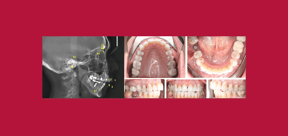 Class II Case Study