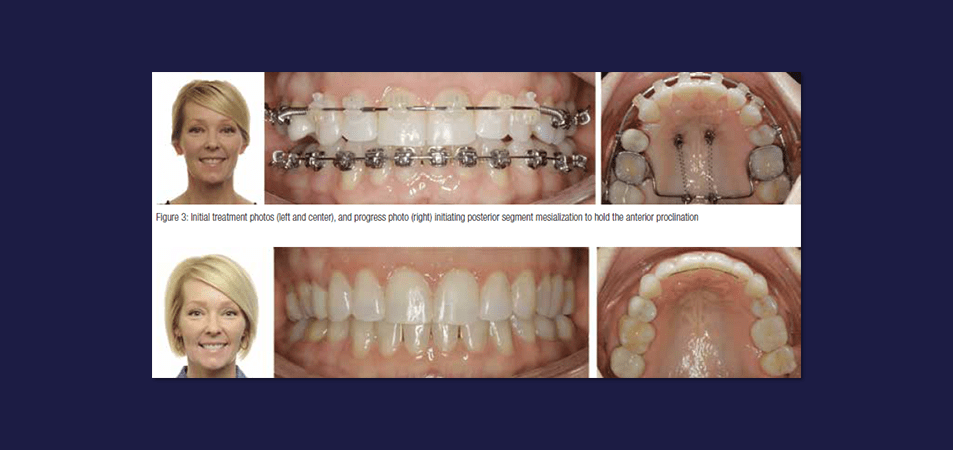 Self-Ligation Case Study