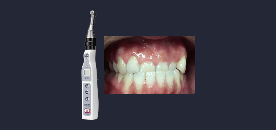 MOPs Anterior Cross Bite Case Study