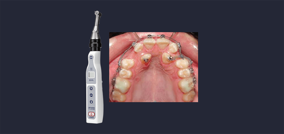 MOPs Impacted Canines Case Study