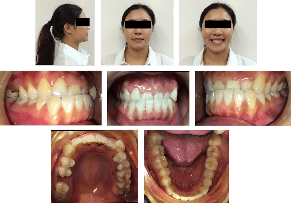 MOPs Anterior Cross Bite Case Study