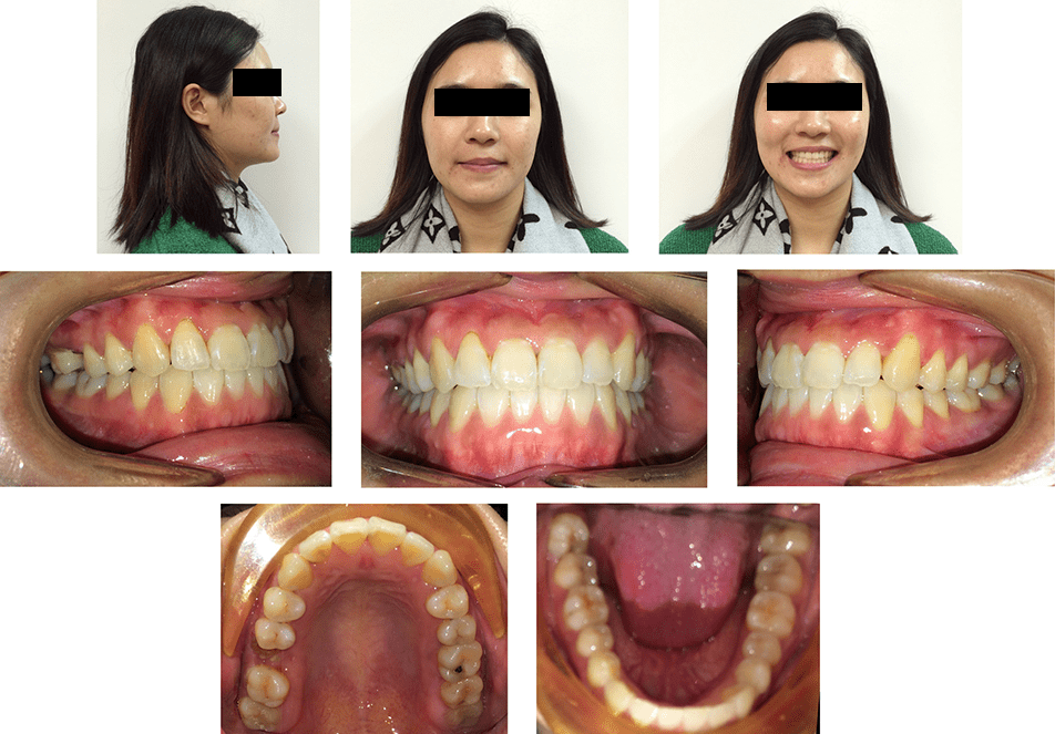 Anterior Crossbite (3 Months) 2 MOPs Anterior Cross Bite Case Study