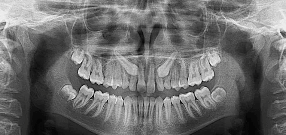 Impacted Canines (6 Months) 1 MOPs Impacted Canines Case Study