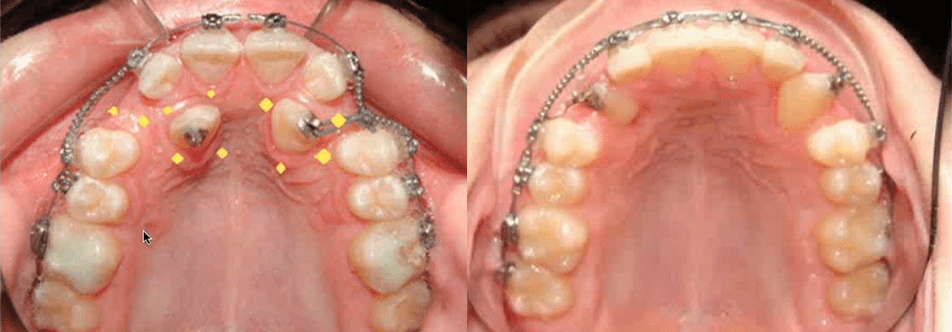 MOPs Impacted Canines Case Study