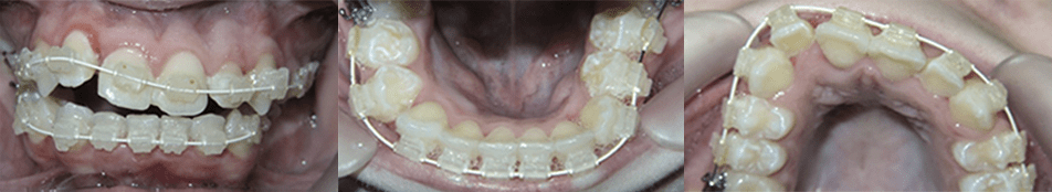 Severe Crowding (8 Months) 1 MOPs Severe Crowding Case Study