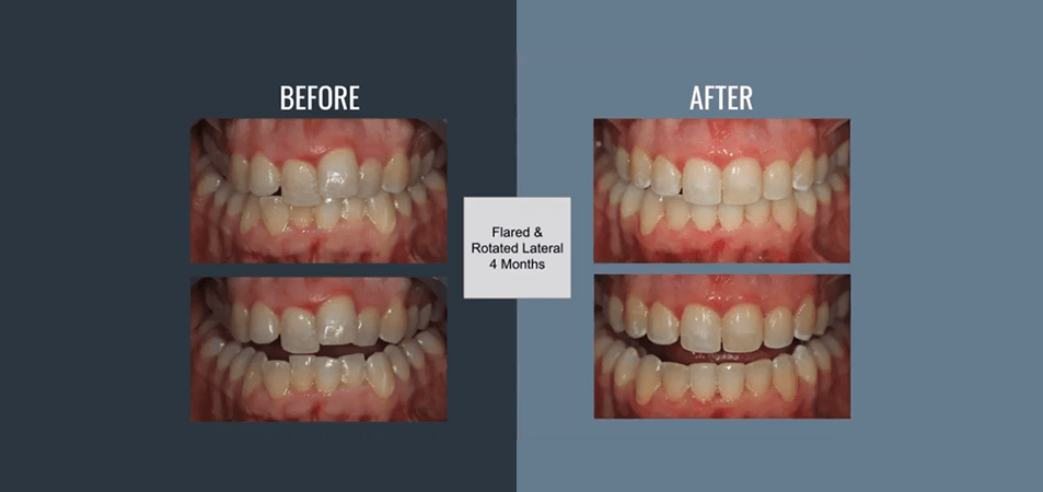 Flared & Rotated Lateral 4-Month Case Study