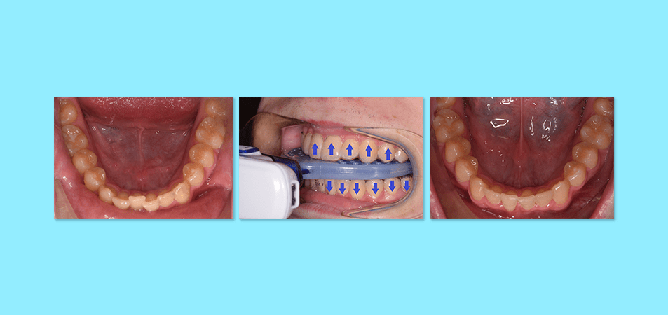 Accelerated Orthodontics Case Study