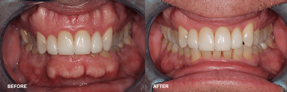 Accelerated Invisalign Before and After