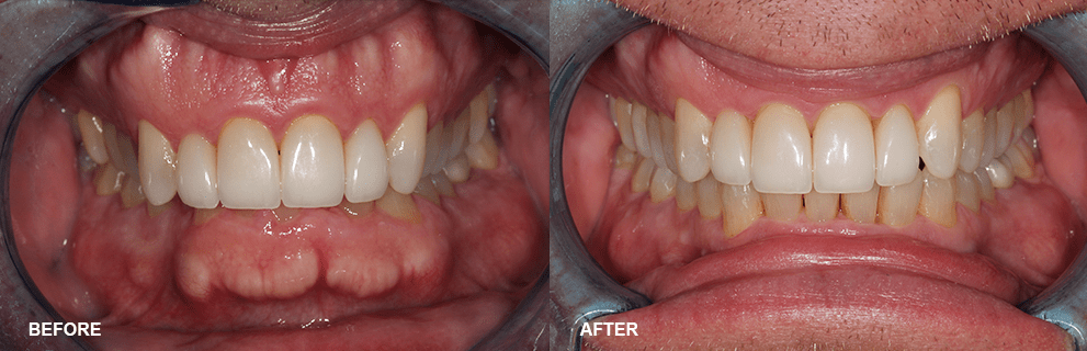 Doctor Spotlight: Grant Olson 1 Accelerated Invisalign Before and After