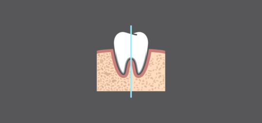 El-Bialy T. et. al, JOS: HFV Tooth Movement and Bone Density | Propel ...